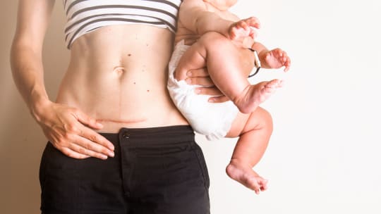 Woman After C-Section 