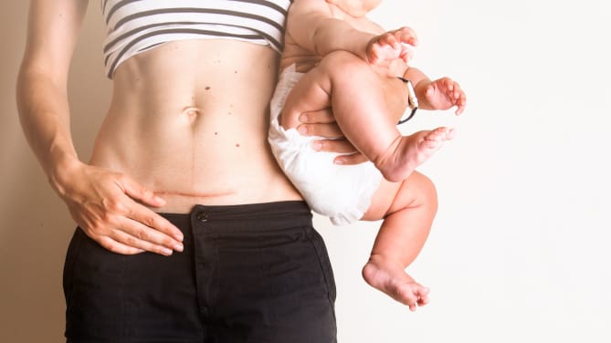 Woman After C-Section 
